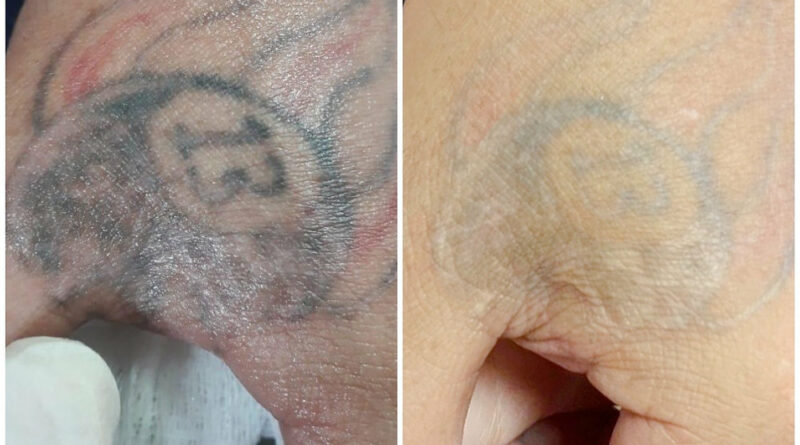 Does tattoo removal hurt?  Understand the entire process